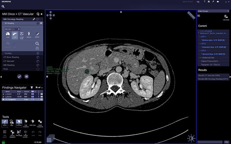 nspka CT recist