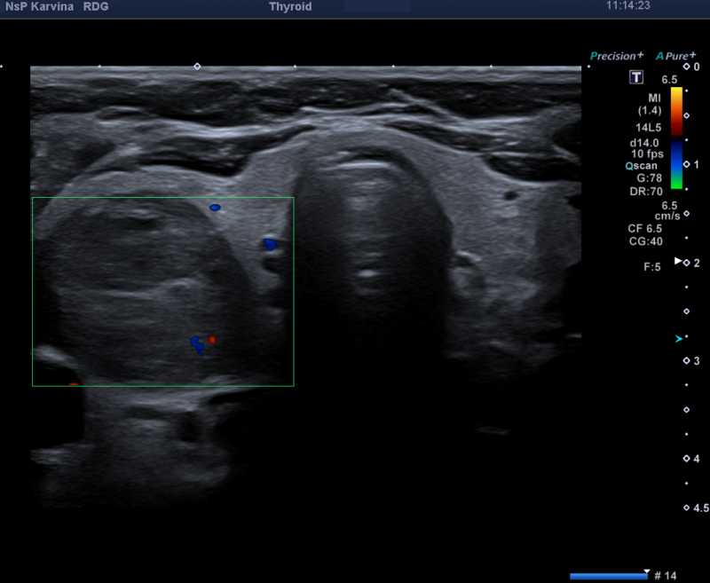 thyroid